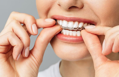Clear Aligners