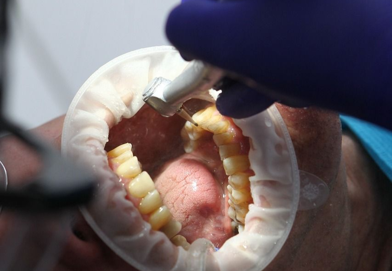 emergency Dental Care