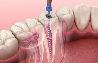Root Canal Treatment