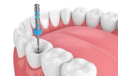 Traditional Braces