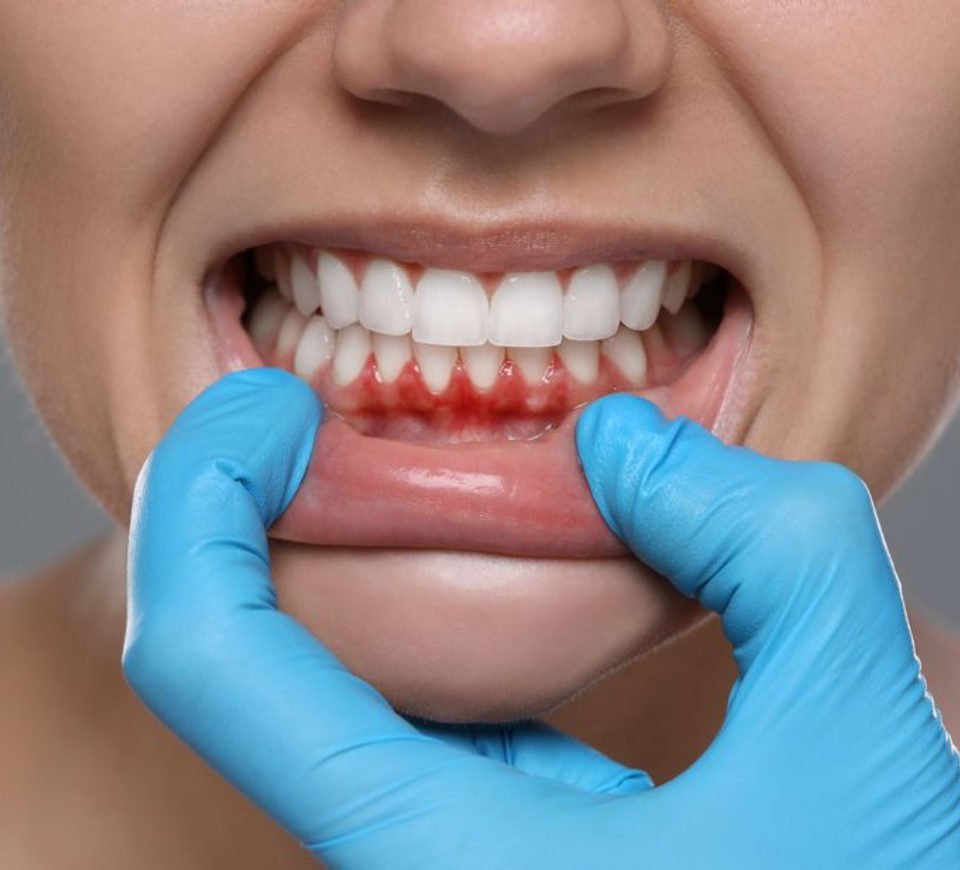 Tooth Extractions